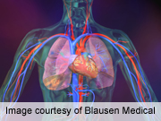 Heart Lung Machine slide01 Asthma Linked to Increased Risk of Dangerous Lung Blockage