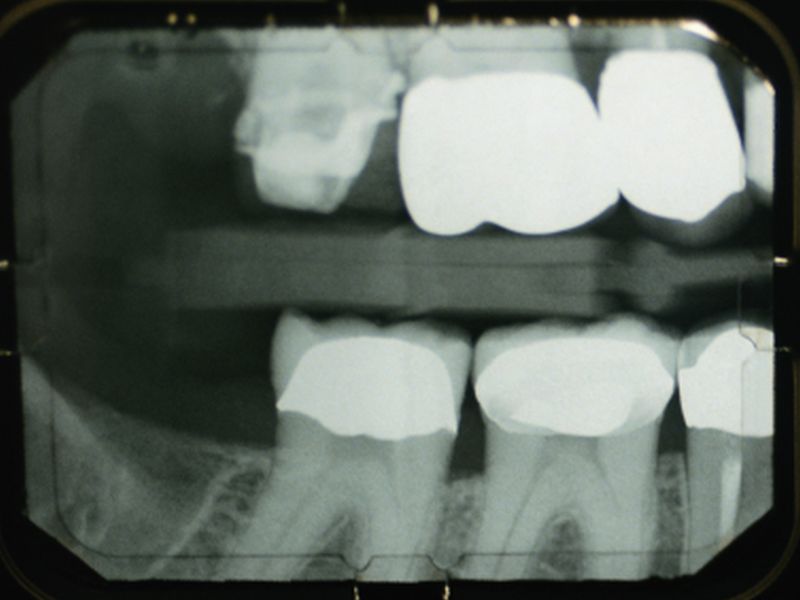 Can teeth repair themselves without fillings? 