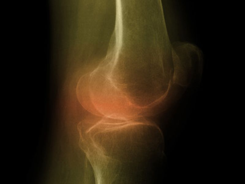 Knee Arthritis: Steroid Shots May Not Help Long-Term, Ozone Injections Promising