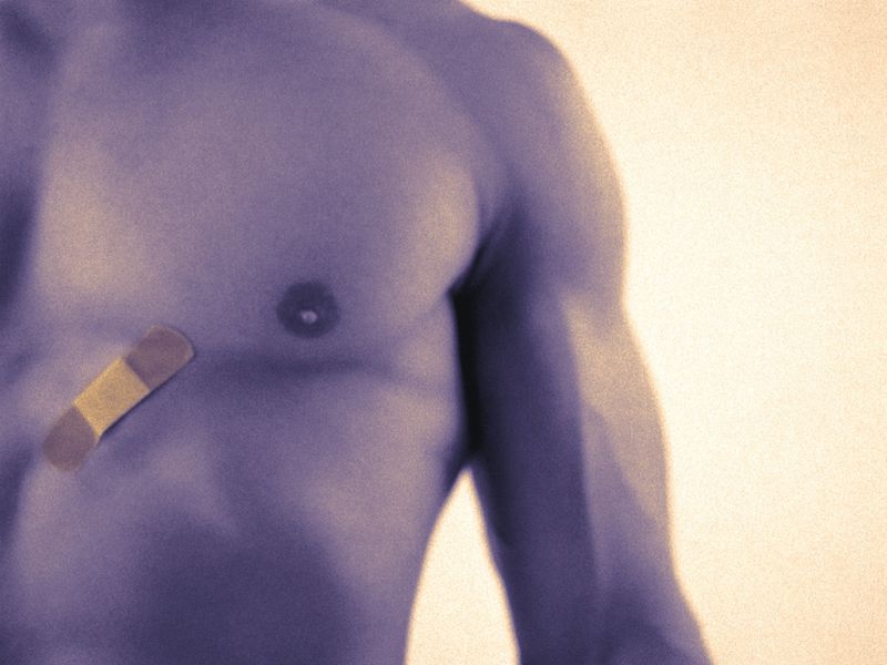 Many Male Breast Cancers Diagnosed Late, and Delays Can Be Lethal