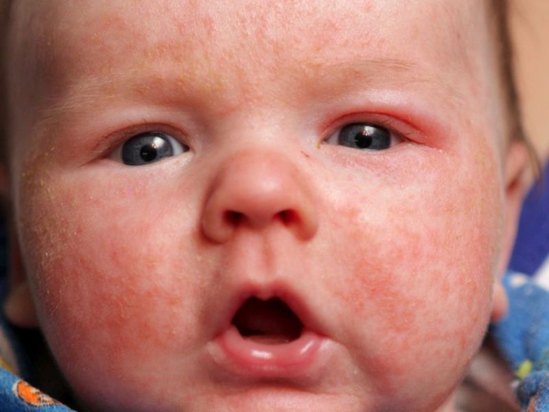 Melatonin Might Help Sleepless Kids With Eczema, Study Finds