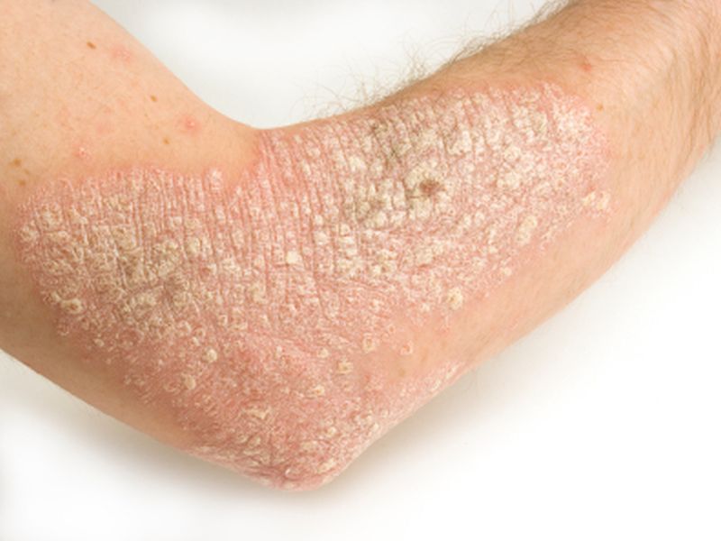 Psoriasis Meds Don`t Raise Risk of Severe COVID-19: Study