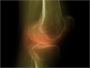 Are Steroids Really the Answer for Arthritic Knees?