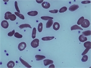 What People With Sickle Cell Disease Need to Know About COVID-19