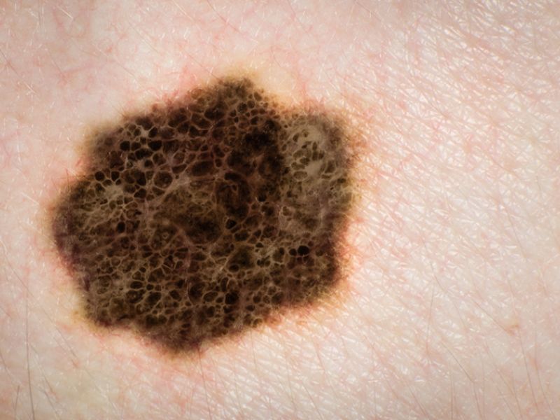 DNA Analysis Might Reveal Melanoma Risk