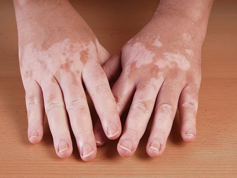 Clinical Features of Vitiligo Linked to Age of Disease Onset |  PracticeUpdate