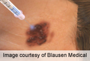 News Picture: Combo Treatment for Advanced Melanoma Seems to Improve Survival