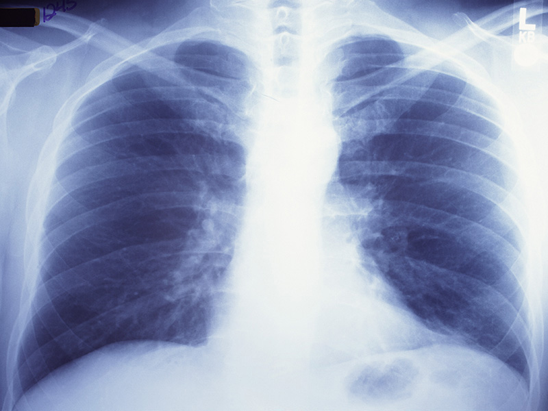 Lung Cancer Report Delivers Good, Bad News