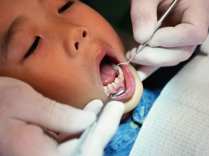 News Picture: Fewer U.S. Kids Are Getting Cavities