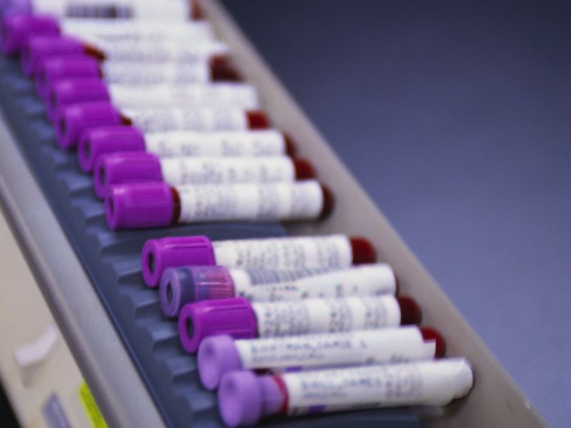 Blood Test Could Spot Those at Highest Risk for Severe COVID-19