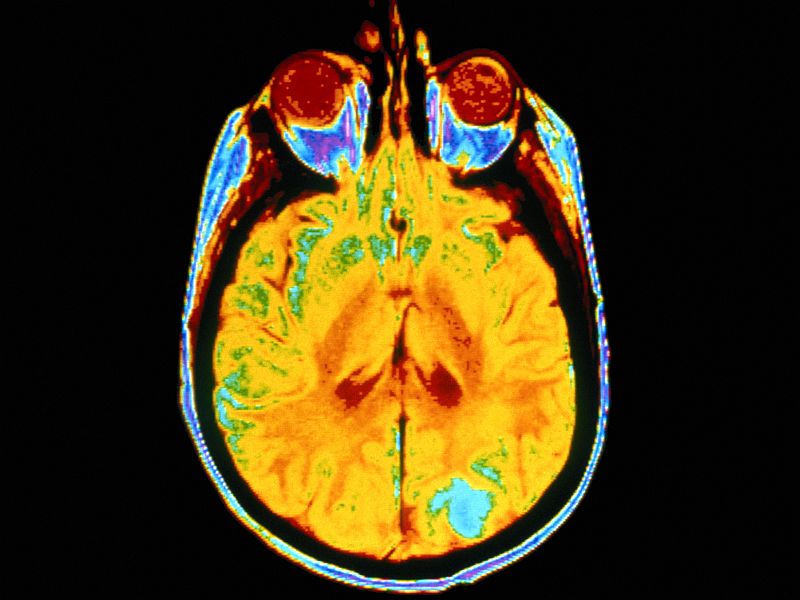 News Picture: Brain Tumors More Common in Better Educated, Wealthier Folks: Study