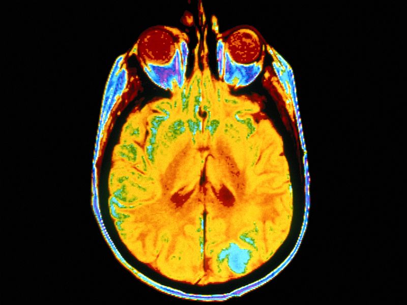 Brain Scans Spot, Track Alzheimer's