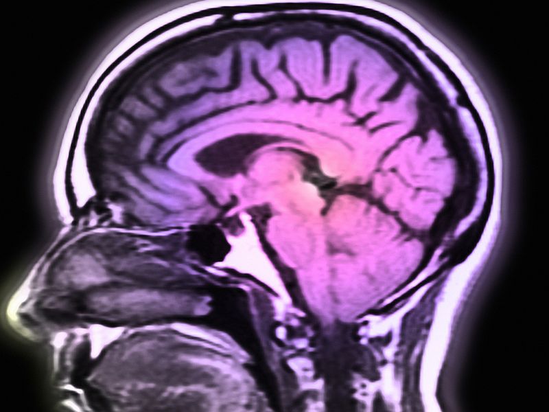 News Picture: Magnetic Brain Stimulation Might Treat Cocaine Addiction