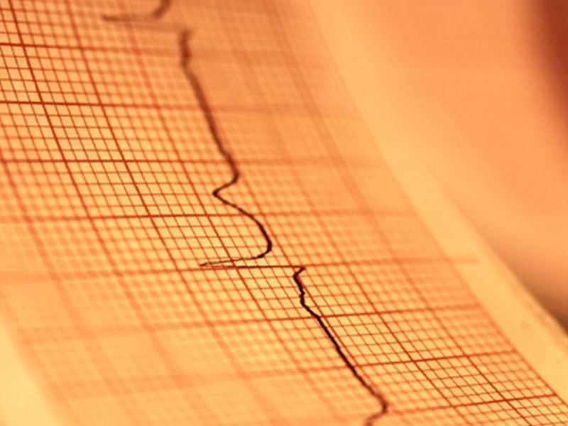 It Looks Like a Classic Heart Attack, But in COVID-19 Patients Other Issues May Be at Play