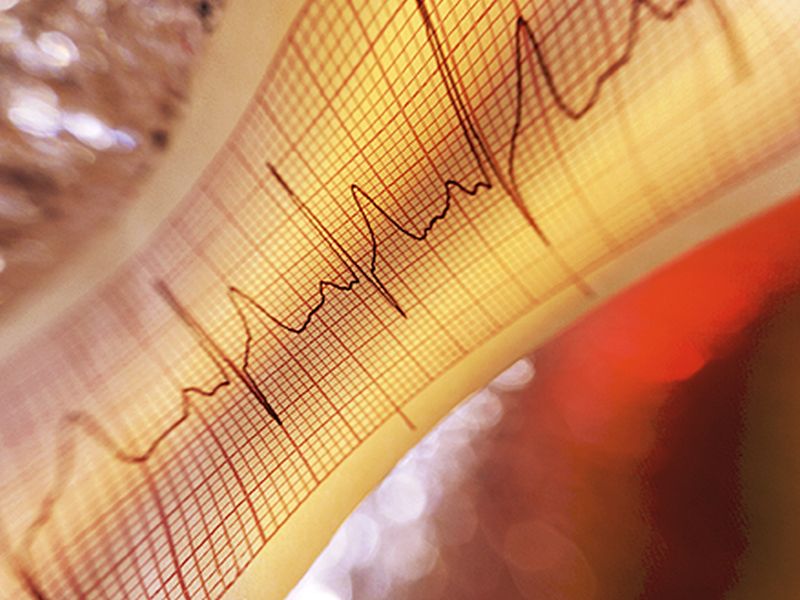 Radiation Rx Might Ease a Dangerous Irregular Heart Beat