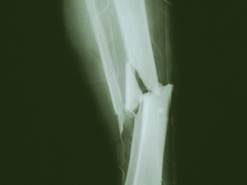 News Picture: Gene Therapy Might Someday Mend Badly Broken Bones