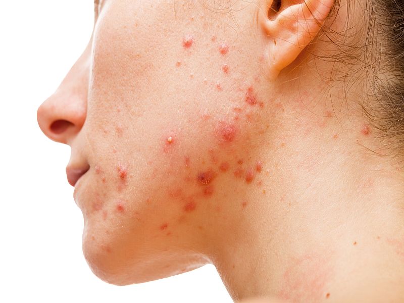 News Picture: Why Acne Can Strike Women After the Teen Years