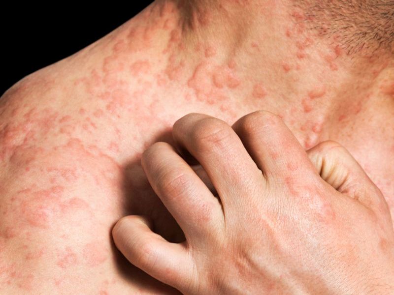 Research Finds Contagious Staph in Lupus-Related Skin Rashes