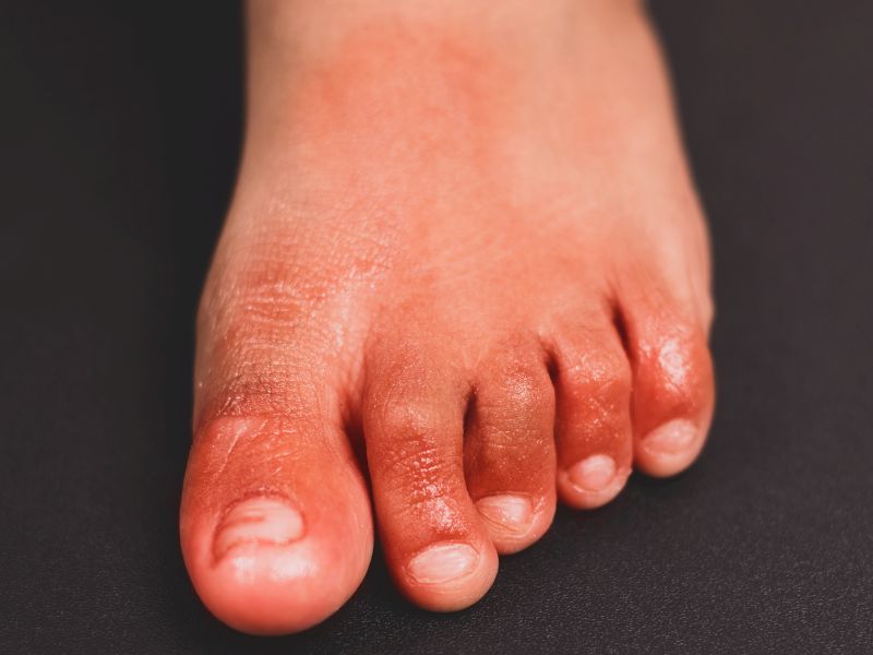 'COVID Toe' Lesions Probably Not Caused by COVID-19, Studies Find