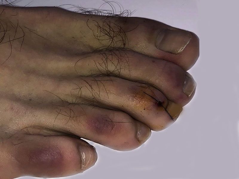 News Picture: More Symptoms of Coronavirus: COVID Toes, Skin Rashes