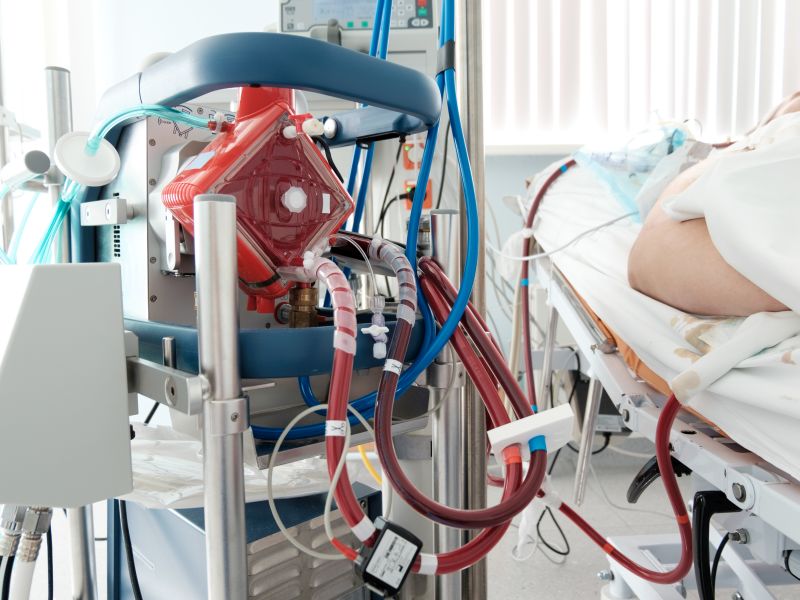 News Picture: ECMO: Technology That Might Help COVID Patients When Ventilators Can't