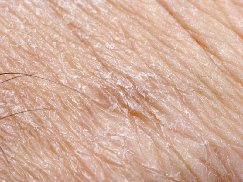 News Picture: Novel E-Skin May Monitor Health, Vital Signs