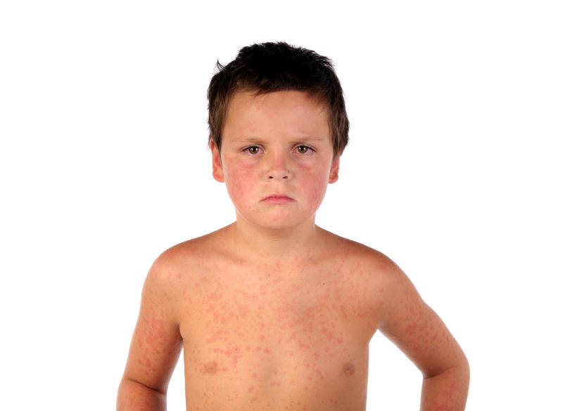 Measles Leaves People More Vulnerable to Future Infections