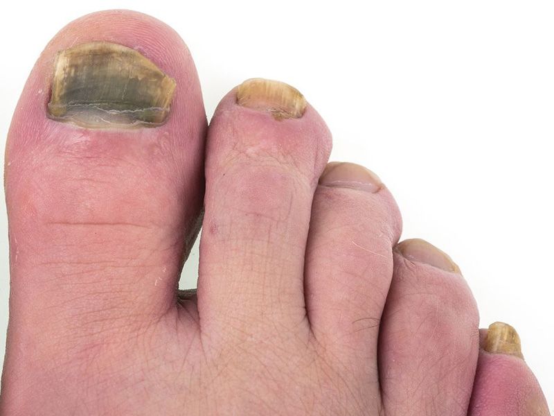 How To Treat Black Toenail Fungus