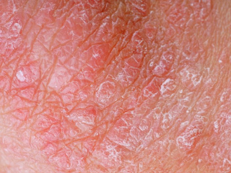 When Traditional Rx Fails, Psoriasis Patients Seek Alternatives