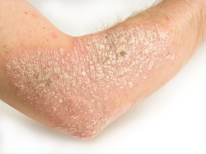 psoriasis and covid 19 risk