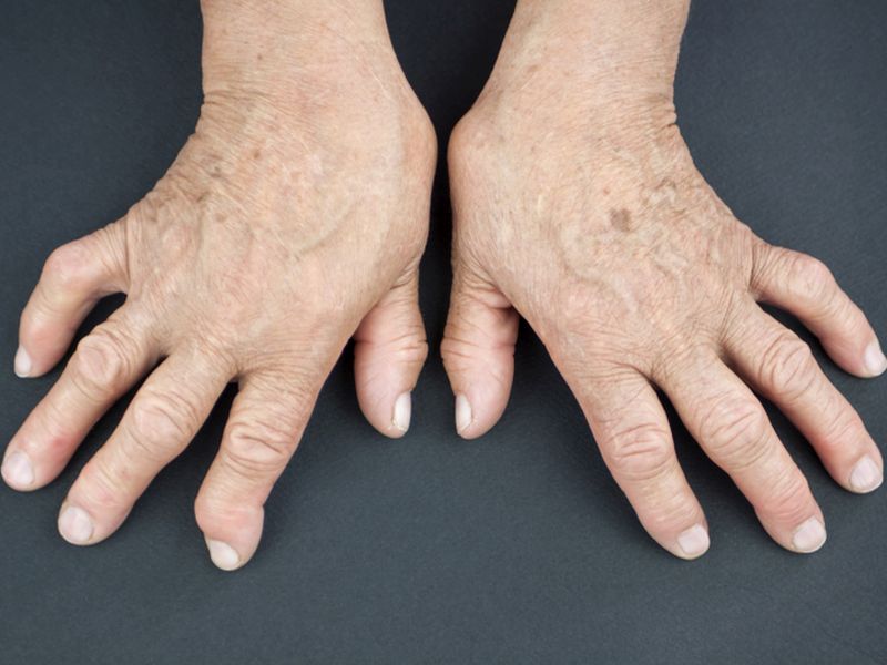 Signs of Rheumatoid Arthritis Can Show Up Long Before Diagnosis