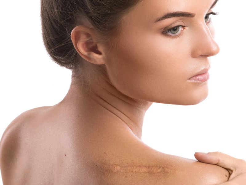 News Picture: Patients, Doctors Often Differ About Scars After Surgery