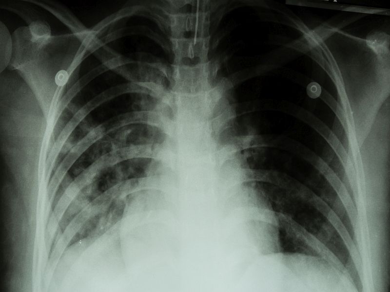 FDA Approves Drug for Most Deadly Form of TB
