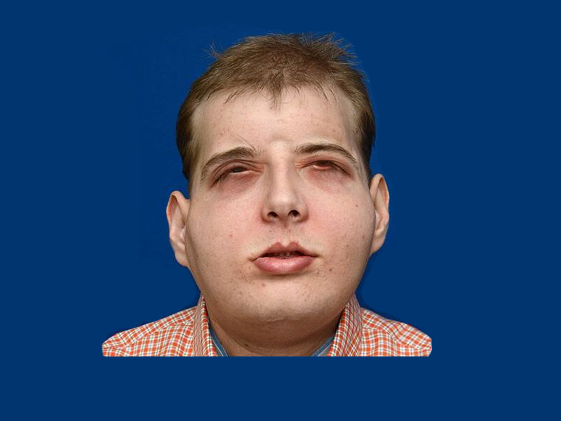 Firefighter Receives Most Extensive Face Transplant Ever 5697