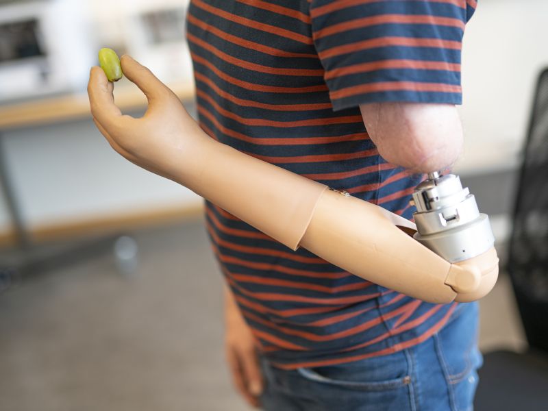 High-Tech Prosthetic Arm Melds With Patient's Anatomy