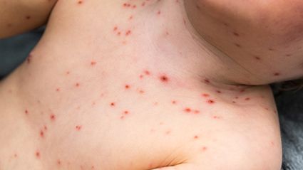 Chickenpox Vaccine and Shingles Risk